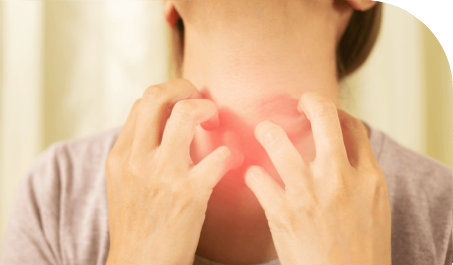 IW - Urticaria crónica ¿qué es?