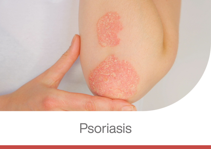 persona con psocoriasis