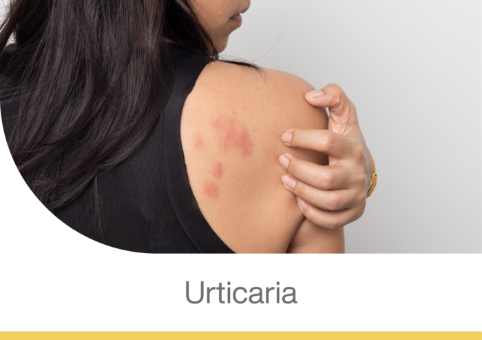 Mujer con urticaria en la espalda