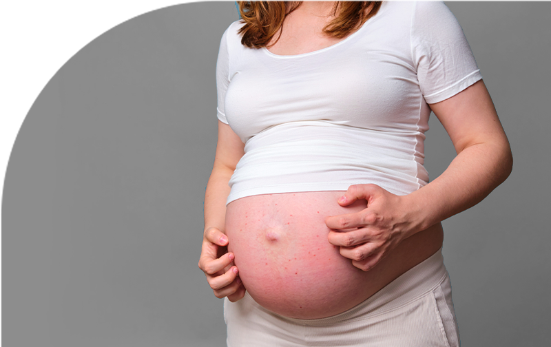 Urticaria Embarazo