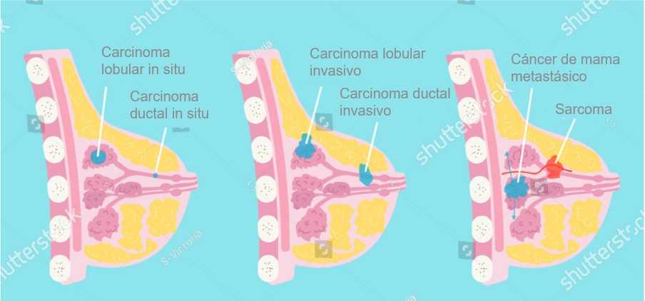 Cáncer de mama