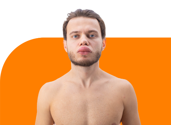 Angioedema ¿otro tipo de urticaria?