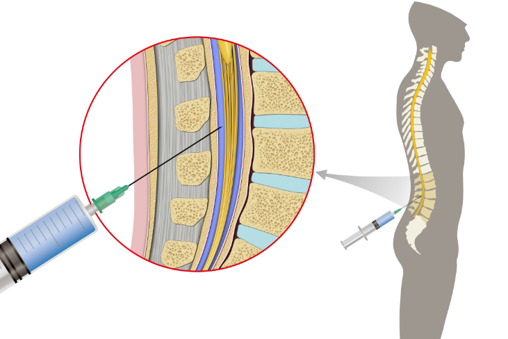 puncion lumbar EM